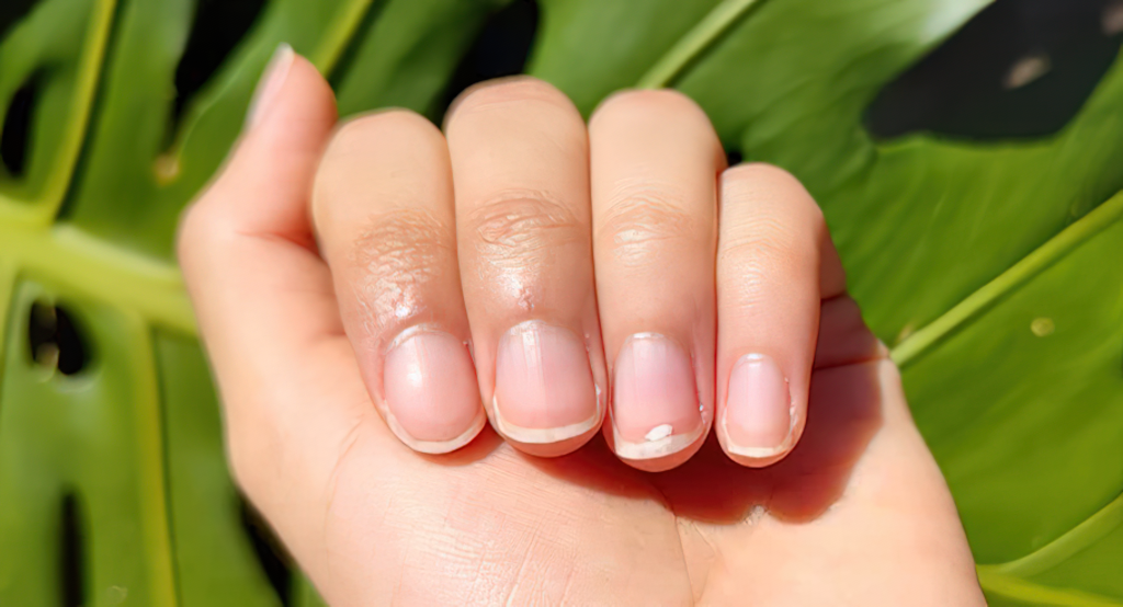 White Spots On Nails Heart Disease